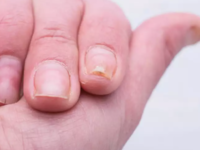 <i class="tbold">ripple</i>s in nails