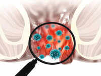 Most common symptom of <i class="tbold">anal cancer</i>