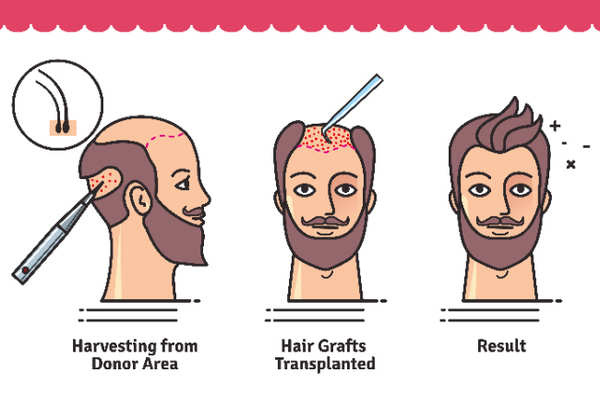 Hair Transplant Facts Steps Surgical Process Everything You