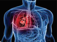 World Tuberculosis Day to be observed today with ‘It’s Time’ theme