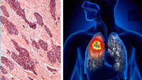 Radiotherapy doubles survival chances of mesothelioma cancer patients