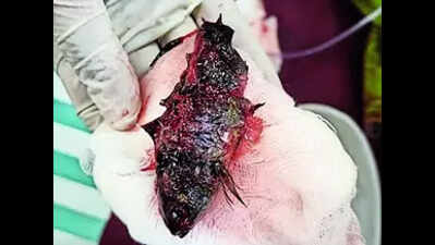 Doctors remove 11cm fish stuck in 11-month-old boy's throat in Karnataka