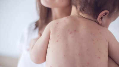 Can measles kill? Here are the key complications to watch out for