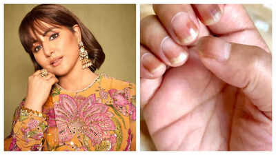 Hina Khan shares photos of her discoloured nails; reveals 'Nail discolouration is one of the most common side effects of chemotherapy'