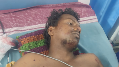 Tribal youth loses hand in firecracker blast near Pollachi