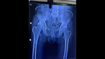 First hip arthroscopy at govt facility performed on 60-year-old at SSG Hospital