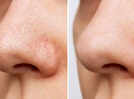 How to remove blackheads at home