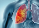 Teen addicted to vaping diagnosed with popcorn lung: Know what it is and what are the risks