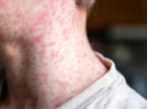 Measles makes a comeback in the US, 700 confirmed cases so far: Safety and prevention tips to follow