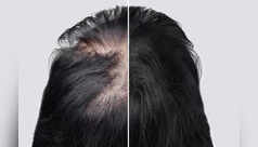 How to grow hair on bald patches using Amla