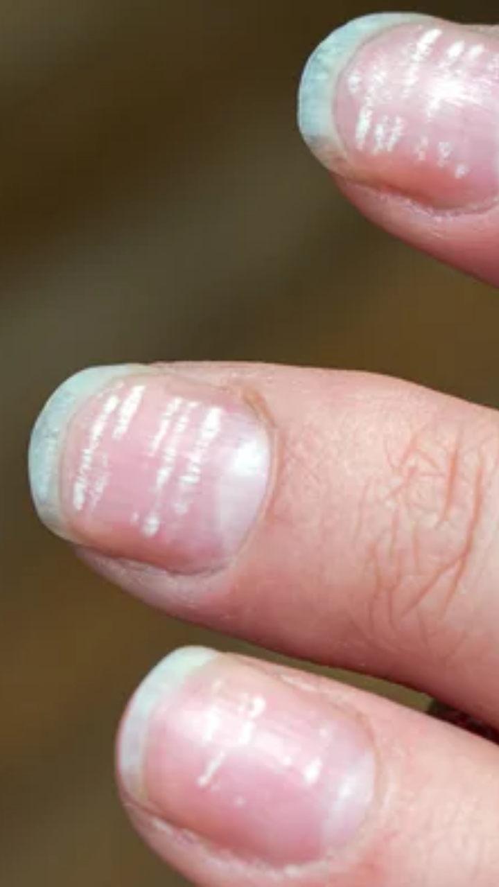 White spots on fingernails? Here's what it means - Healthcare News | The  Financial Express