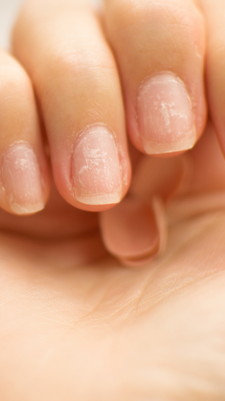 Premium Photo | Nails with white spots on yellow background. leukonychia,  calcium deficit.