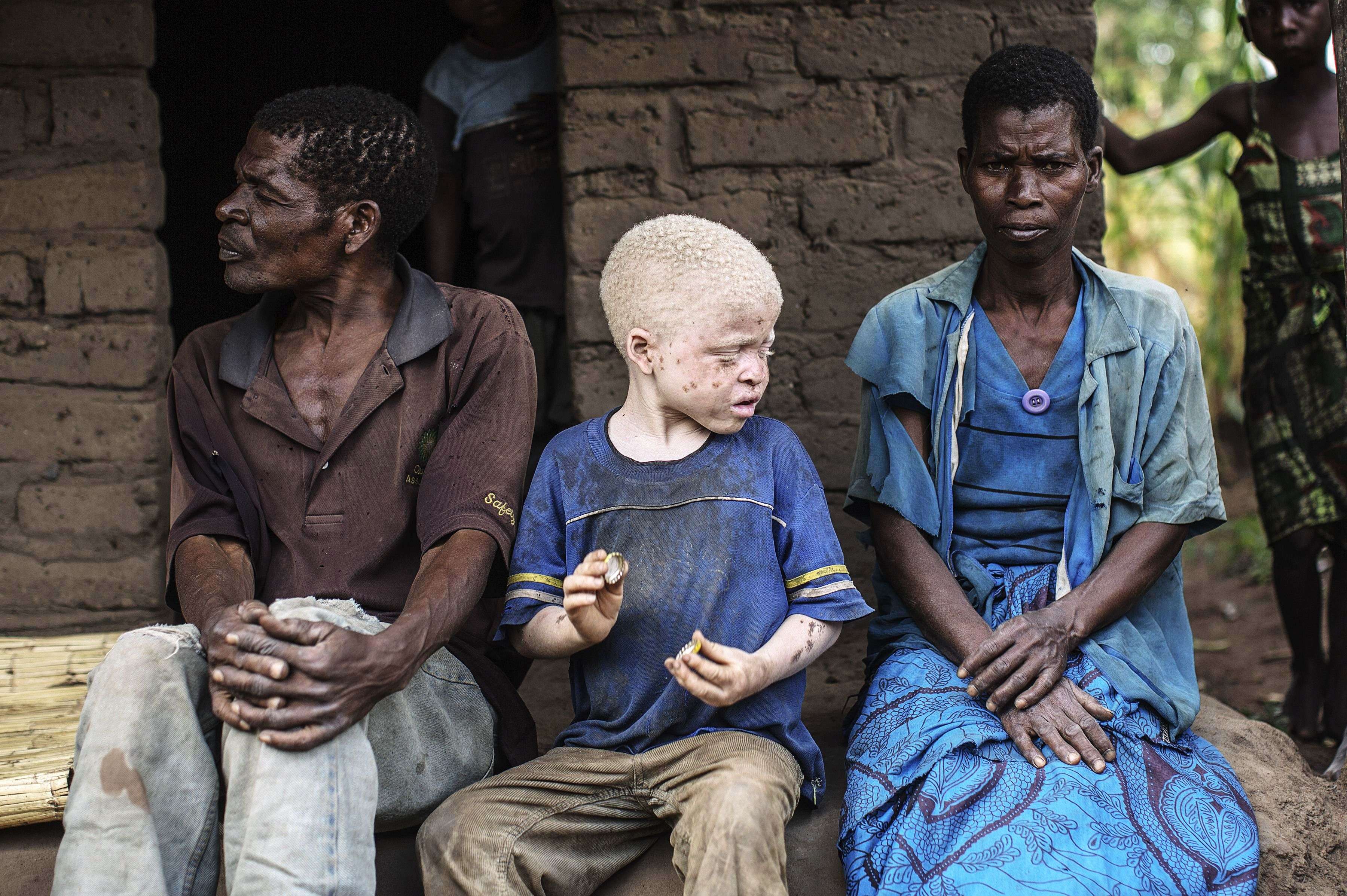 An albino child sits between his parents in the traditional authority area of Nkole, Machinga district. Six albinos have been killed in the poor southern African nation since December, according to the Association of Persons with Albinism in Malawi. (AFP PHOTO/GIANLUIGI GUERCIA)