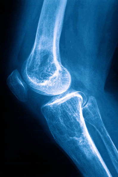 Osteoporosis, X-Ray