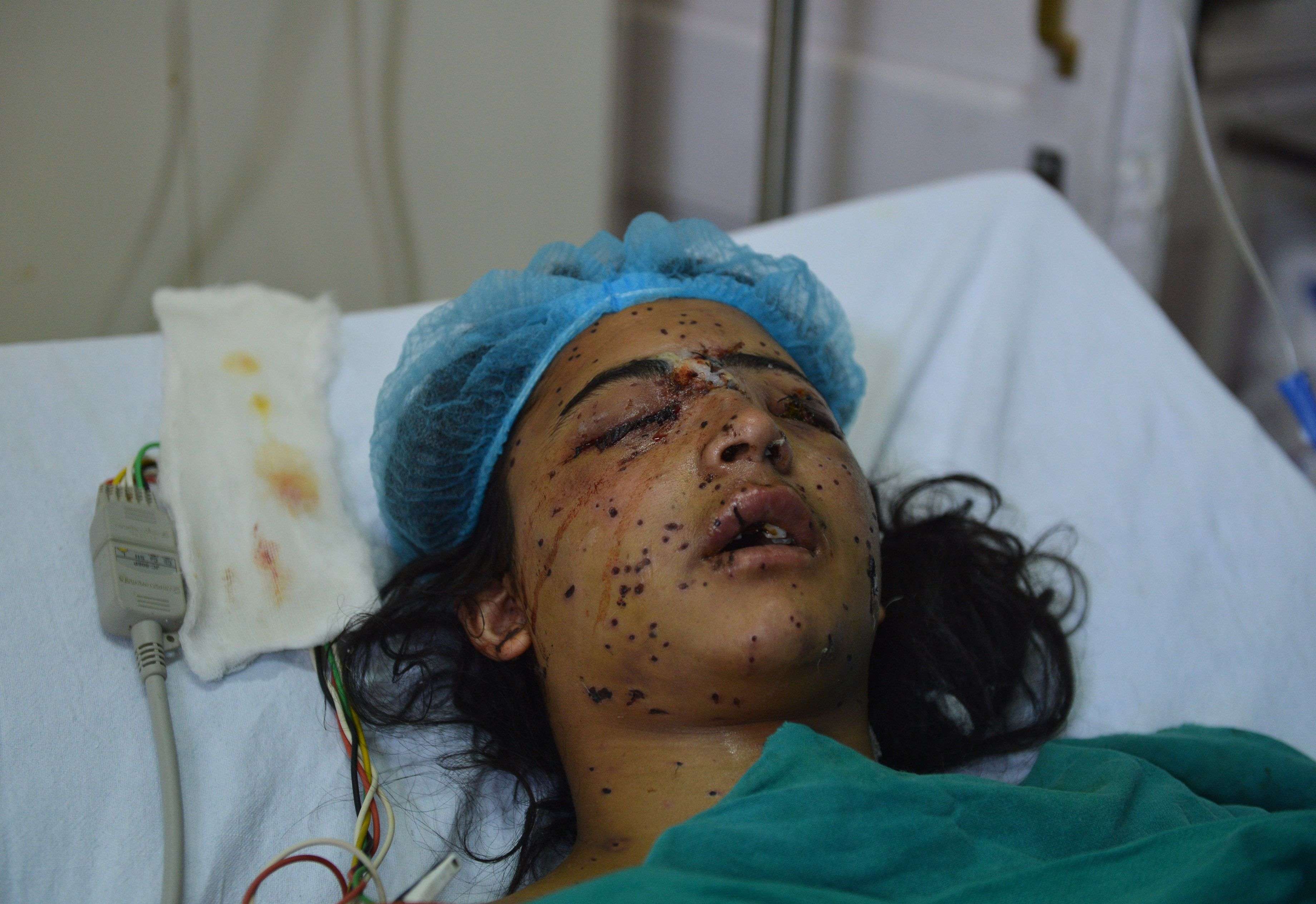 EDITORS NOTE: Graphic content / Kashmiri girl Insha Malik, 14, lays in a hospital bed after being shot with pellets fired by Indian security forces, with doctors saying she had lost vision in both eyes, in the surgical ICU hospital in Srinagar, in India-administered Kashmir on July 16, 2016. According to relatives, Insha was on the first floor of her home when forces fired pellet guns into the building on July 12. She was rushed to the hospital and joined hundreds of injured Kashmiris who have reported devastating eye injuries caused by "non-lethal" pellet gun firings. The death of popular rebel leader Burhan Wani in a gunfight with government forces last week sparked clashes in which more than 3,000 people, including about 200 police officers, have been injured. It is the worst civilian violence to hit the region since 2010, when mass protests broke out and left 120 dead. Hospitals in the main city of Srinagar have struggled to cope with the rush of wounded, hundreds of them with severe injuries in their eyes.  / AFP PHOTO / TAUSEEF MUSTAFA