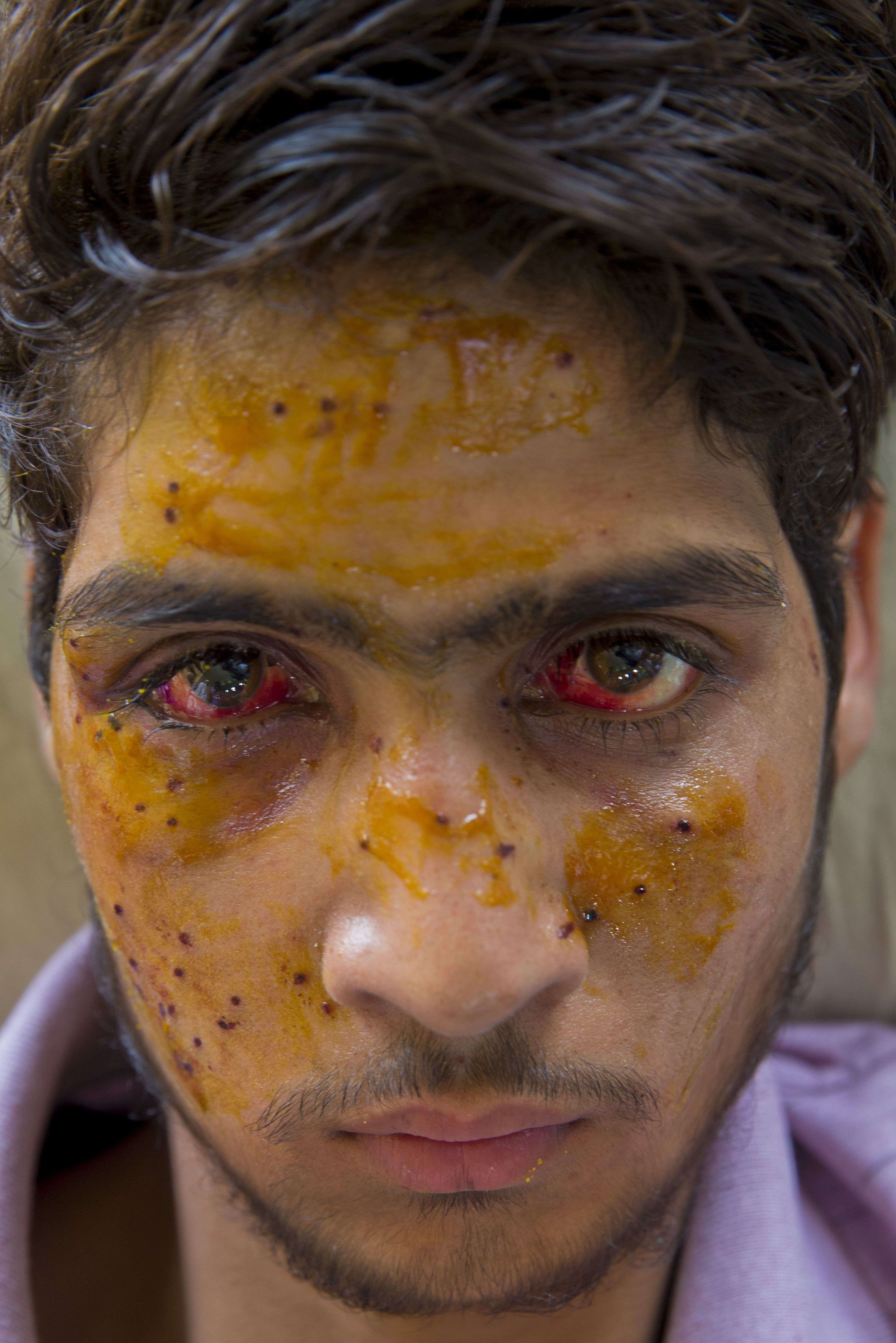 Mohammad Imran Parray, who got wounded after being hit by pellets during a protest recovers at a hospital in Srinagar, Indian controlled Kashmir, Wednesday, July 13, 2016. Hospitals in India's portion of Kashmir are overwhelmed, with hundreds of wounded patients pouring in as the region reels from days of clashes between anti-India protesters and government troops. The violence erupted over the weekend after government troops killed a top leader of Hizbul Mujahideen, the largest rebel group fighting Indian rule in the troubled Himalayan region. (AP Photo/Dar Yasin)