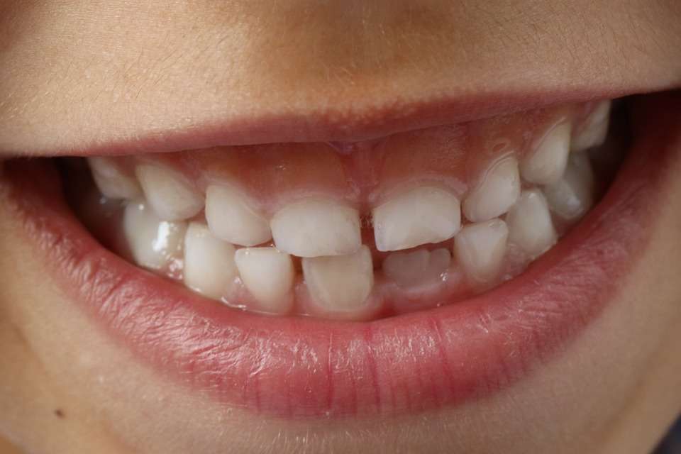teeth-1743981_960_720