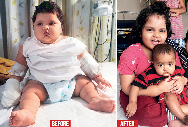 Zoya Khan weighed 18 kg when she was 11 months old. Last year, the eight-year-old’s weight shot up to 40 kg. It’s now down to 31 kg
