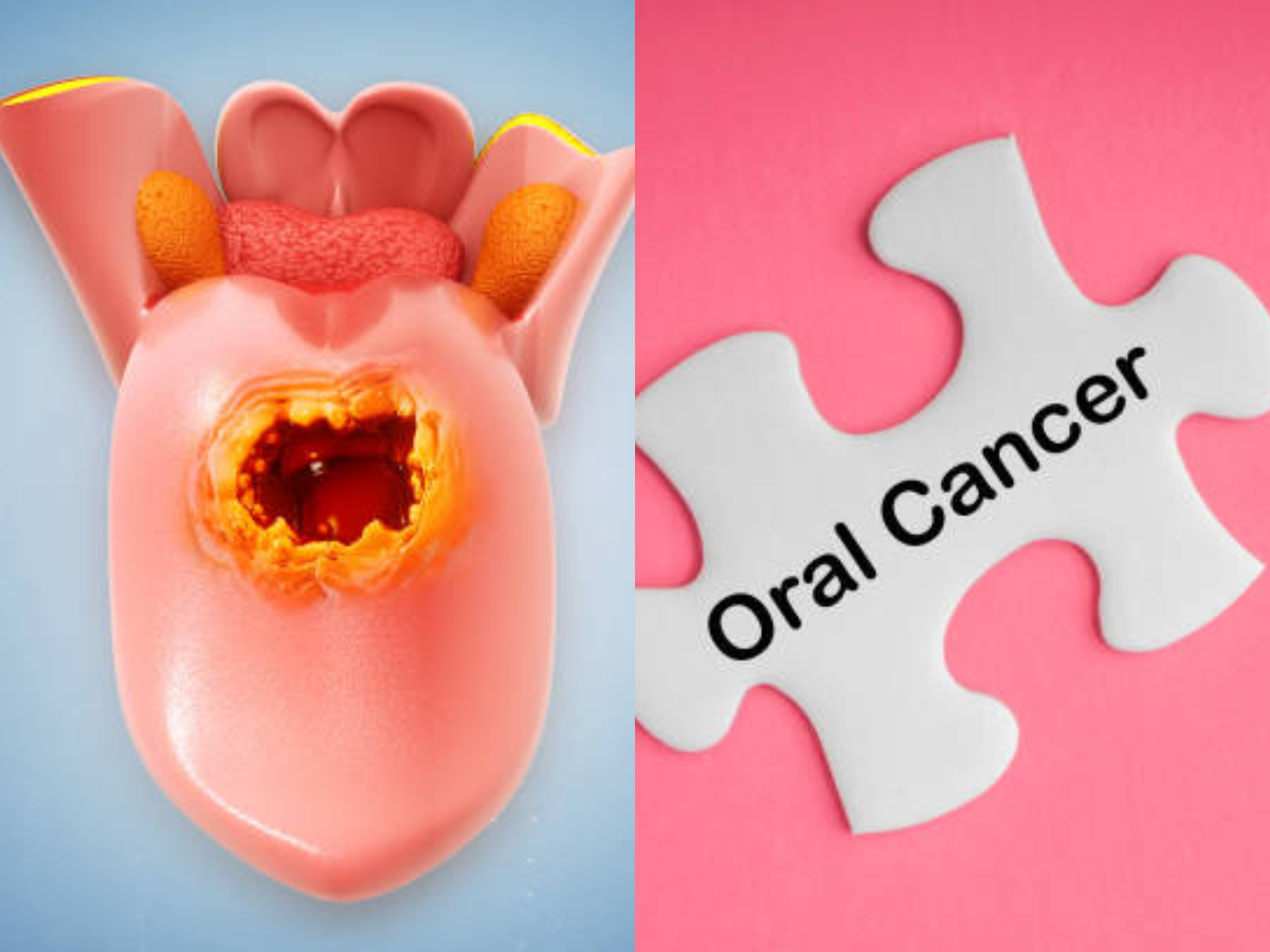 Cancer symptoms: Warning signs of oral cancer you should be checking at home