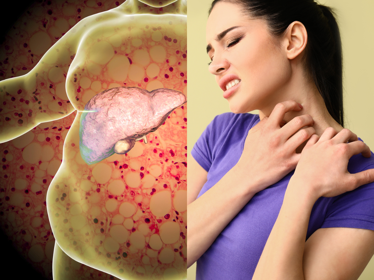 Fatty liver disease symptoms: THESE 4 changes to your skin could be warning signs of liver cirrhosis