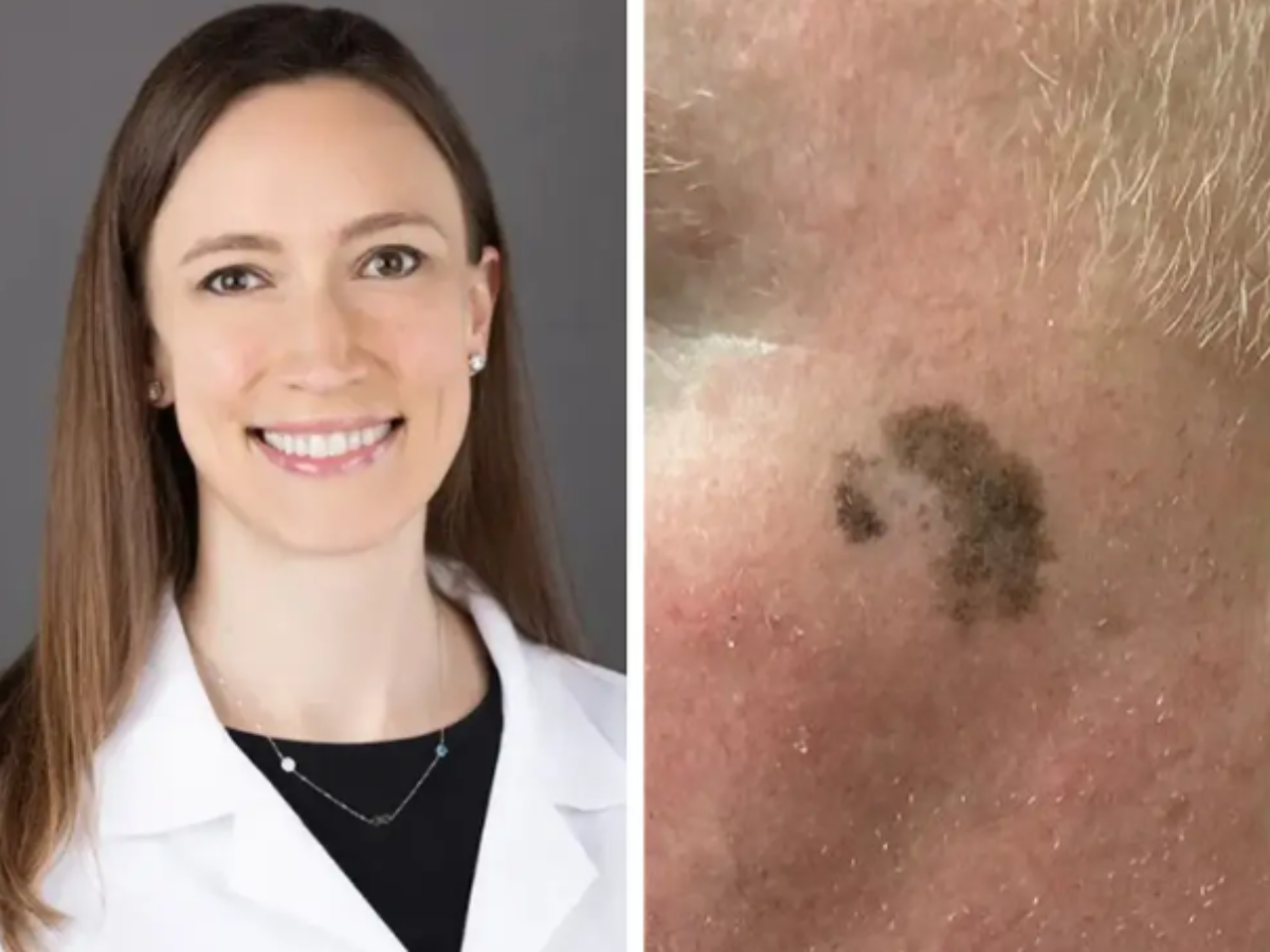 Skin cancer: Dermatologist approached a man on a train for the dark spot on his face; it turned out to be cancer