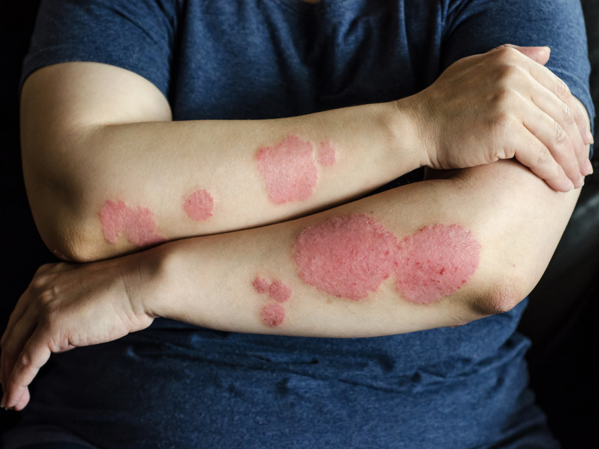 Bad gut health, indigestion can lead to skin disease psoriasis
