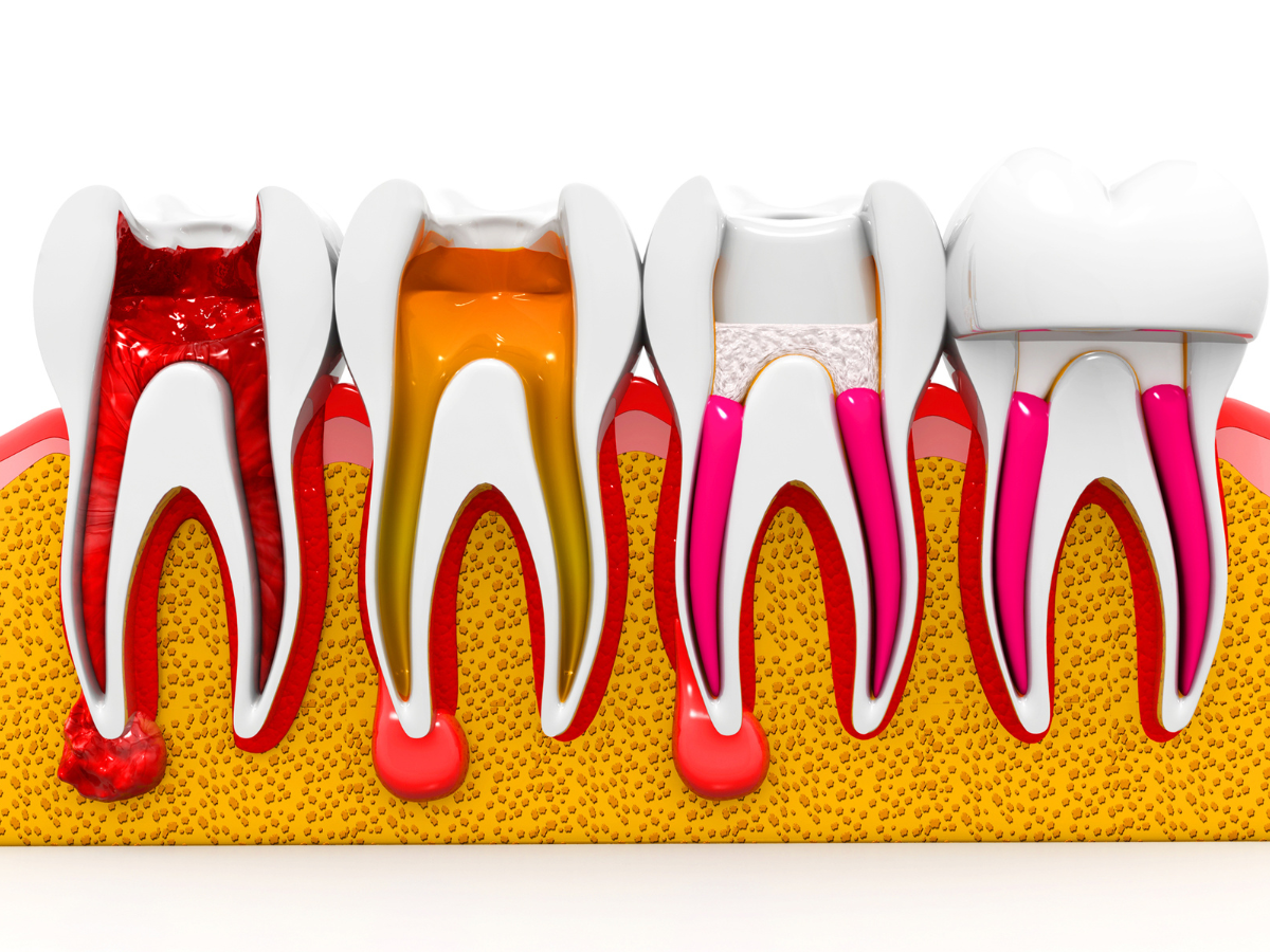 Временное пломбирование каналов зуба. 4 Канальный пульпит зуба.