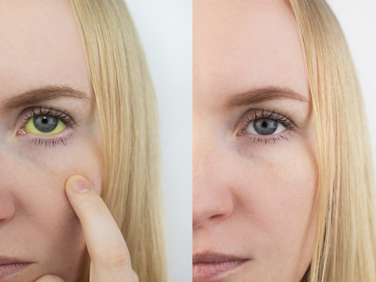 5 symptômes d’alerte d’une maladie du foie sur votre visage