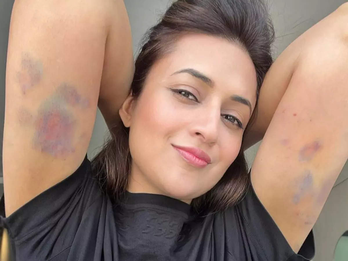 Khatron Ke Khiladi 13: Divyanka Tripathi reveals battle scars, shares photo of her bruises