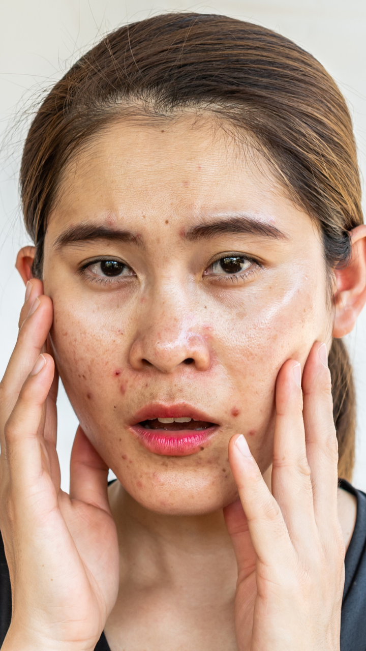 Zinc Deficiency Rashes Zinc Deficiency Skin Face