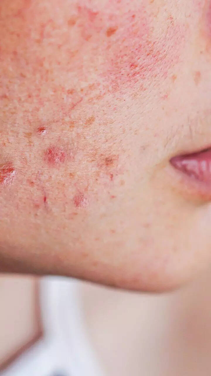 8 Signs Of Vitamin C Deficiency That Appear On Your Skin StorialTech