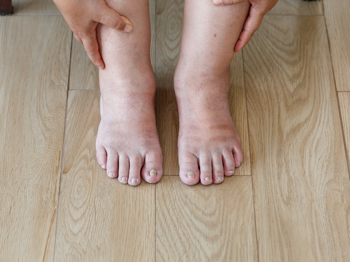 Diabetic nerve damage How to protect your legs and feet