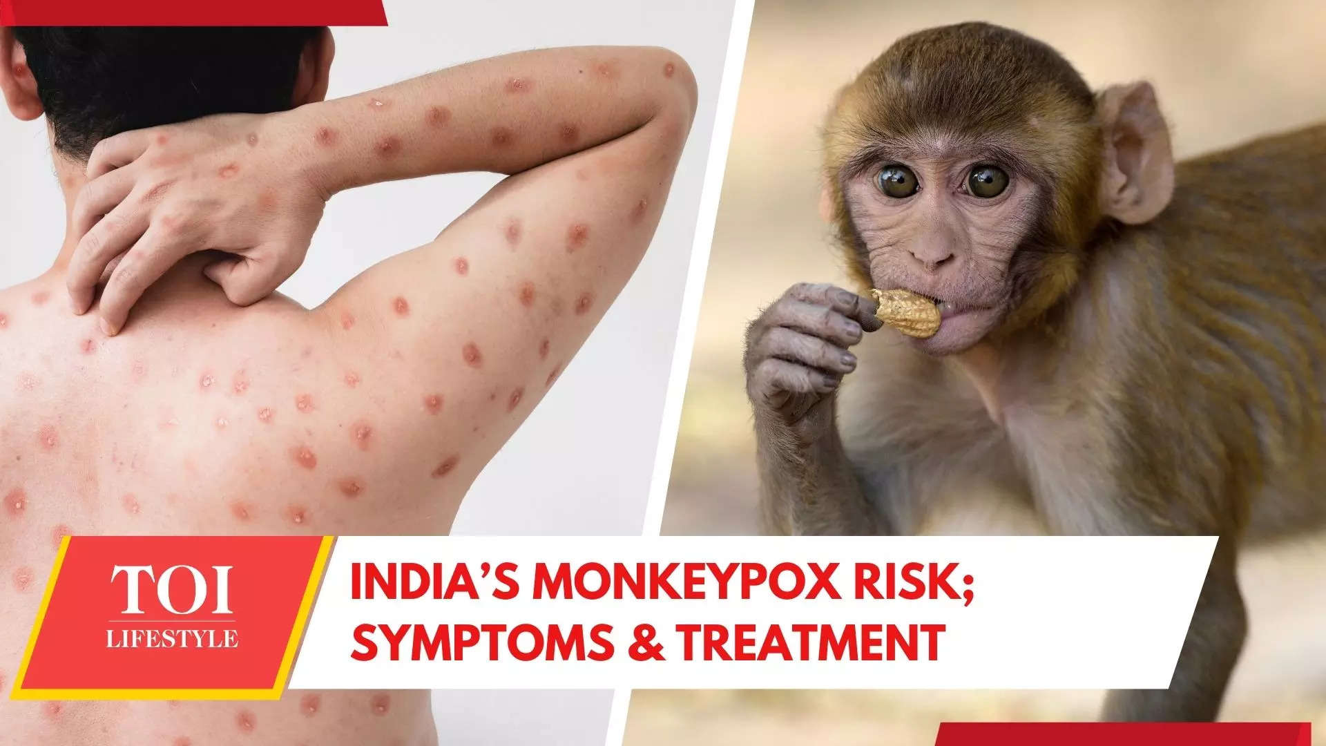 Monkeypox Scare In India: Signs, Treatment And Facts You Need To Know