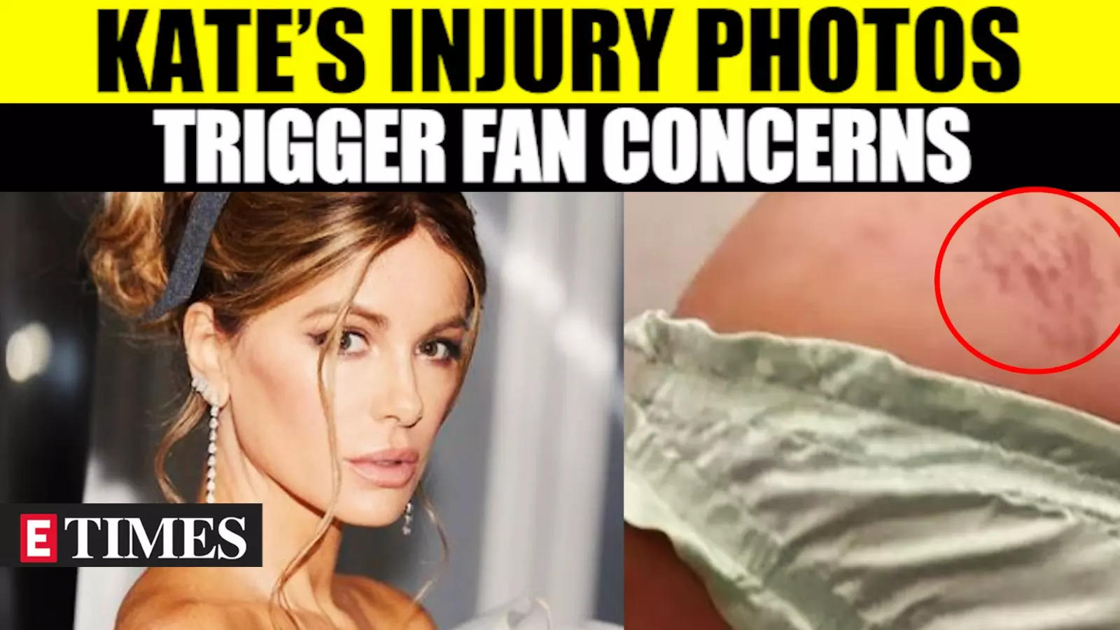 Kate Beckinsale Shares Injury Photos: Fans Express Concern