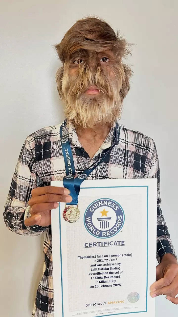 Meet Lalit Patidar: Man with the hairiest face sets Guinness World Record |  Times of India