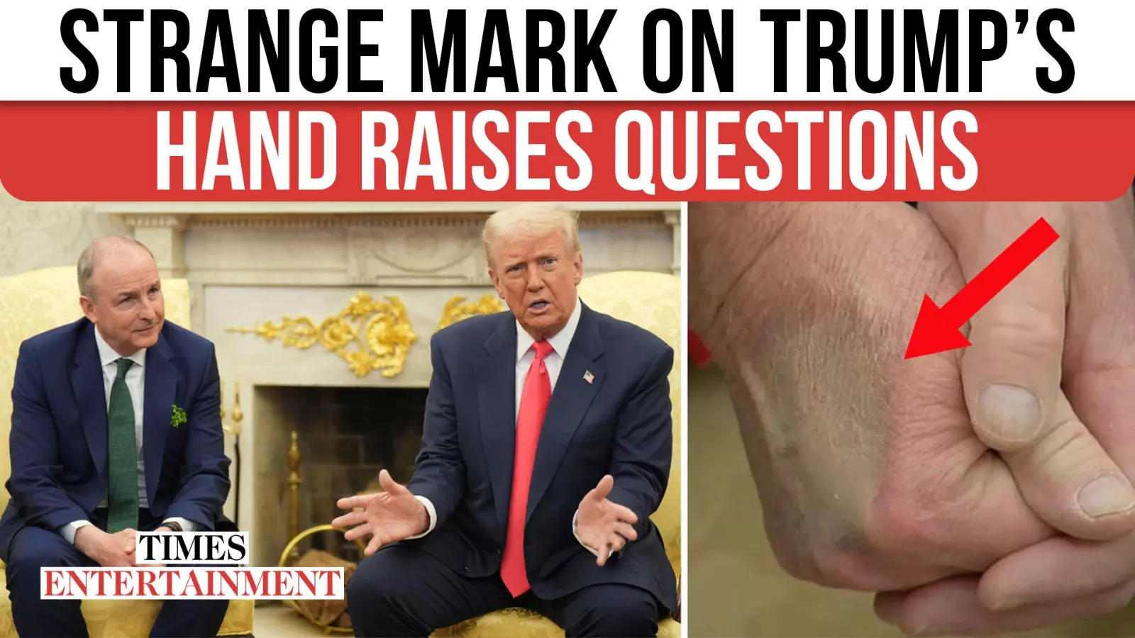 Trump’s Hand Shows STRANGE Bruise; Make-Up or Health Scare? Experts Give Worrying Update