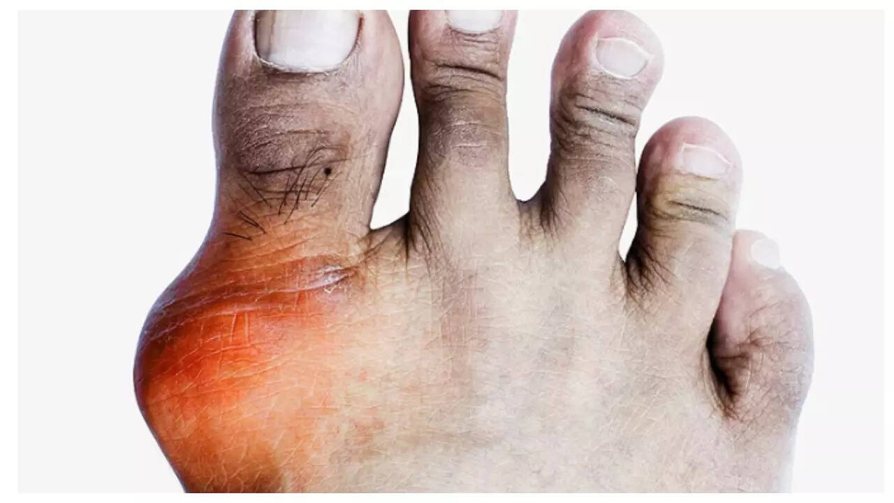 एक महीने में यूरिक एसिड स्तर को कम करने के लिए 7 युक्तियाँ