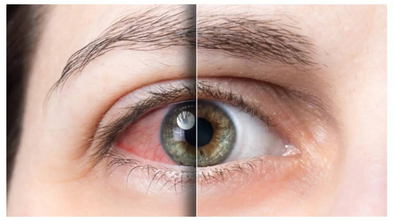 Diabetes Symptoms: 5 ways Diabetes impacts the eyes
