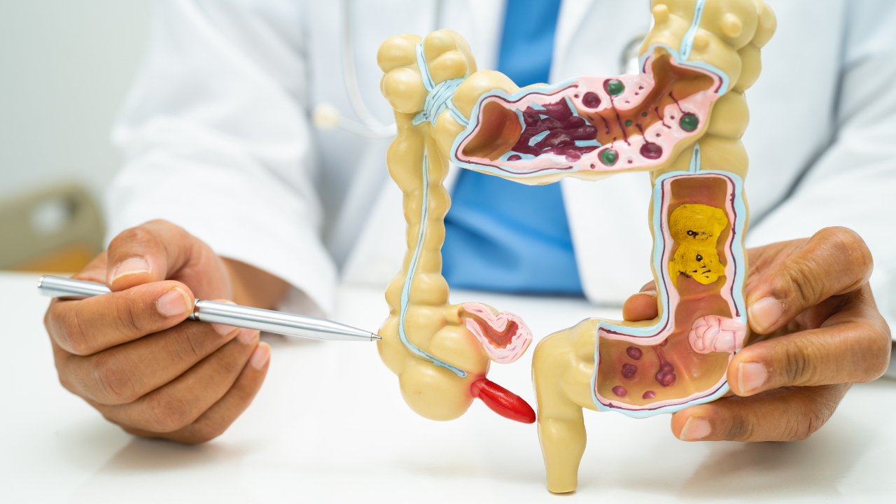 Appendix cancer cases on the rise in youngsters: 5 early signs that go unnoticed - Times of India