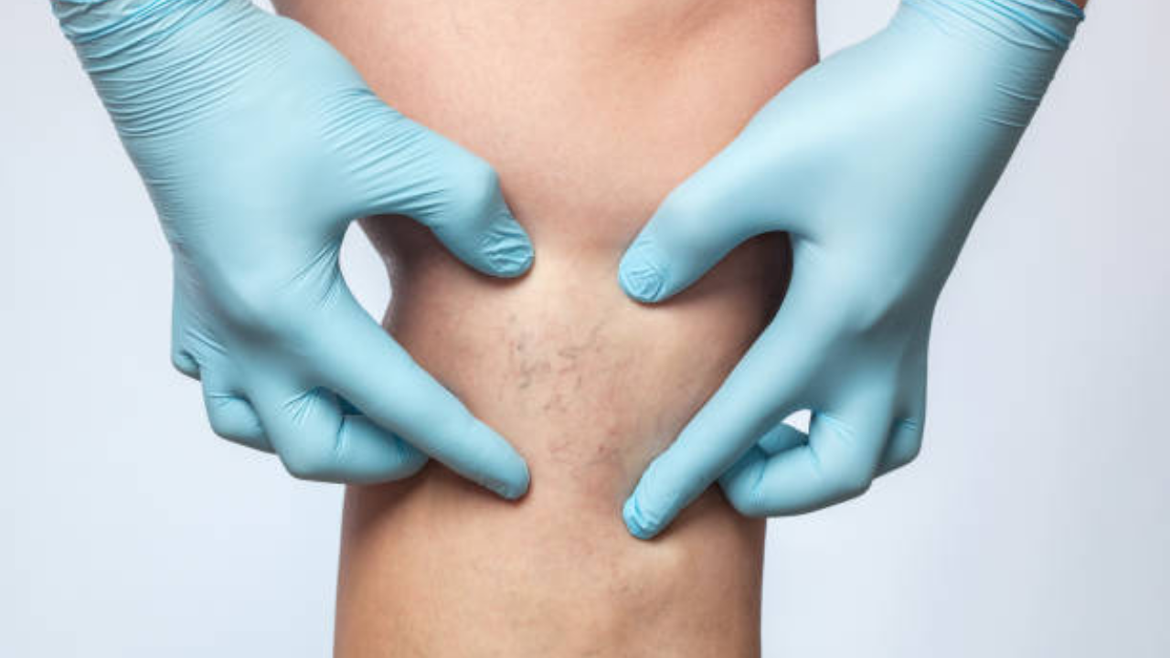 Chronic venous insufficiency: 9 reasons why it happens and how to identify it early
