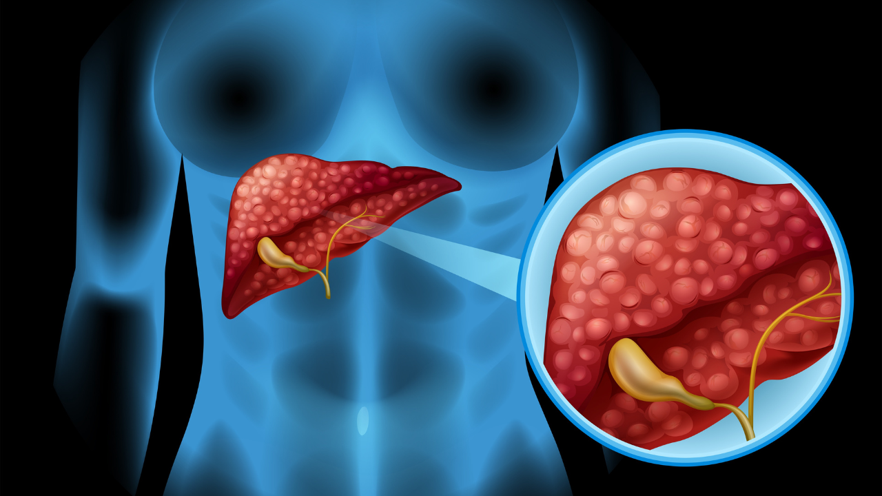 Fatty liver: What diseases this liver condition can trigger