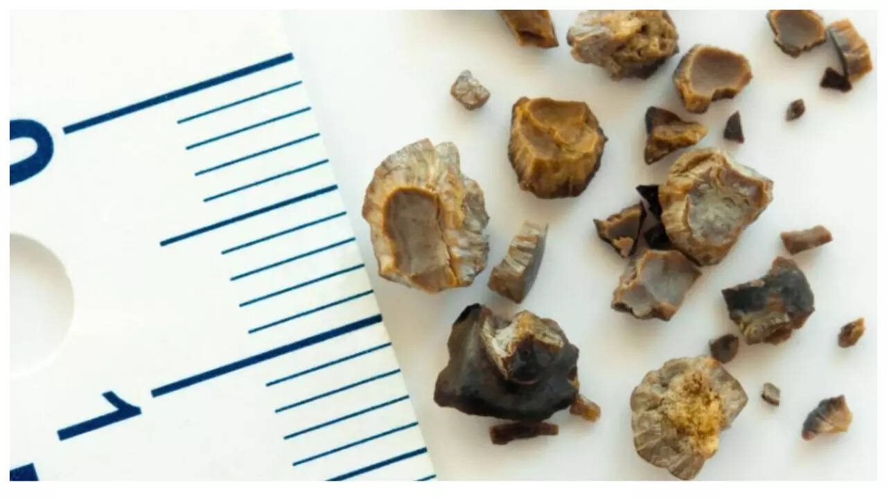 Why do stones get formed in the kidney and gallbladder: 4 things to do to prevent them