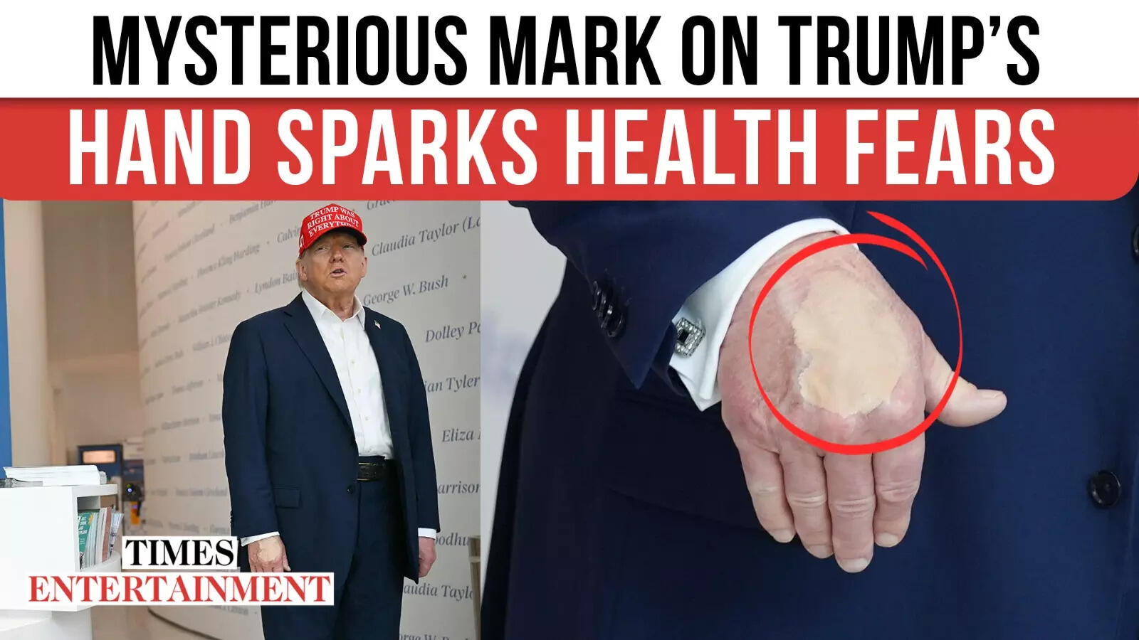 Unseen Bruises Coated By Make-up Gas Recent Doubts About Trump’s Well being And Psychological Sharpness