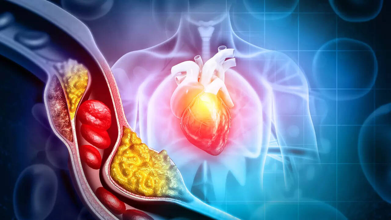 How to reverse plaque to prevent a heart attack, according to a US doctor
