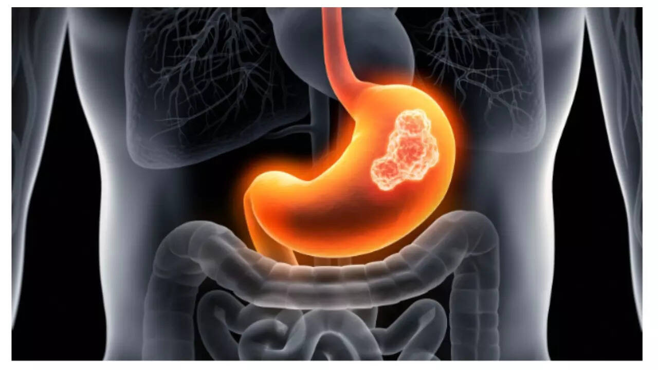 Stomach Cancer Prevention: 5 foods that can help keep stomach cancer at bay