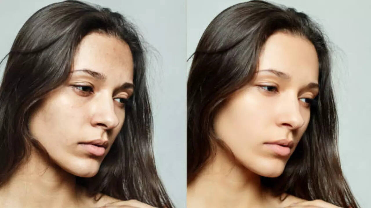 Skin Care: How to use Chia Seeds to remove dark spots from skin
