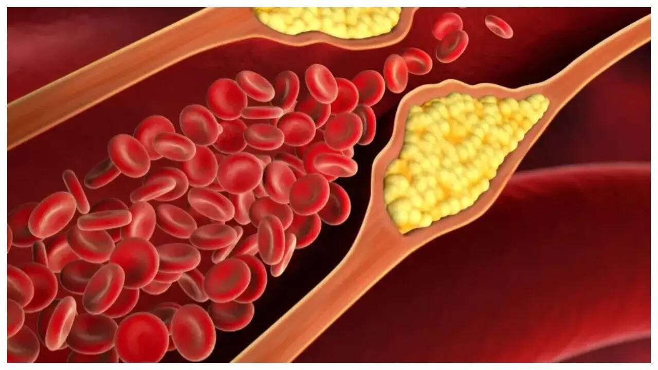 Cholesterol Lowering Foods: 5 natural foods to help bring down cholesterol in 3 months