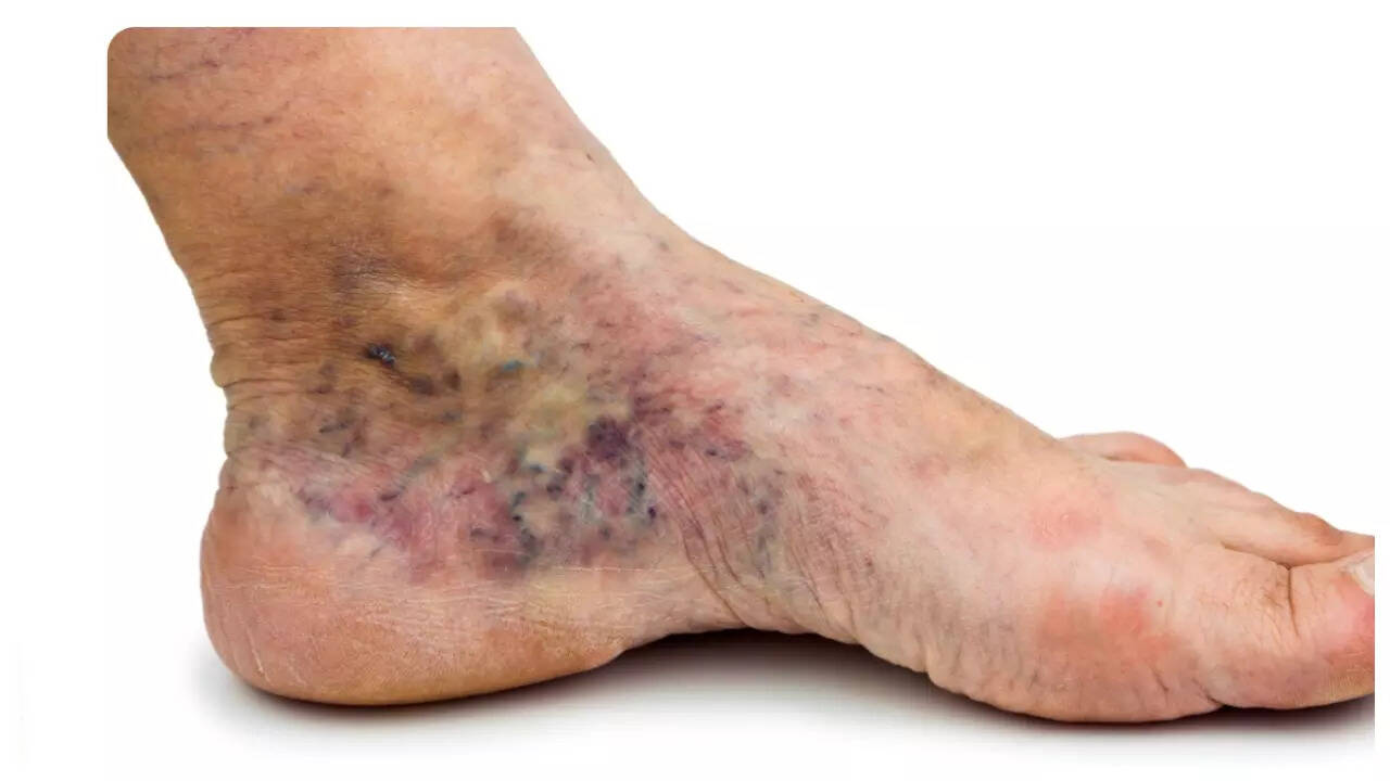 पेरिफेरल आर्टरी डिजीज (पीएडी) के 6 चेतावनी लक्षण, जैसा कि शीर्ष संवहनी सर्जन द्वारा बताया गया है