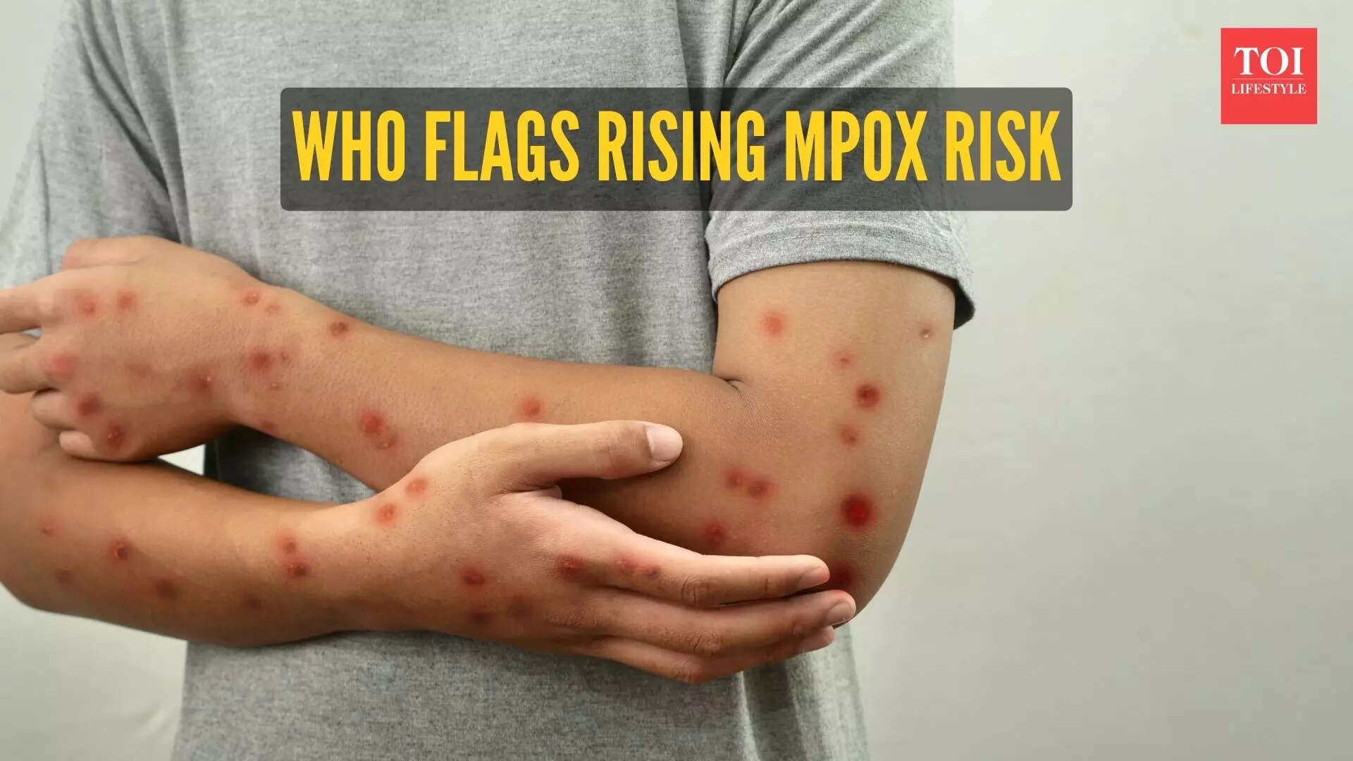 WHO warns of rising 'clade Ib' Mpox cases worldwide: 5 symptoms we should watch out for – The Times of India