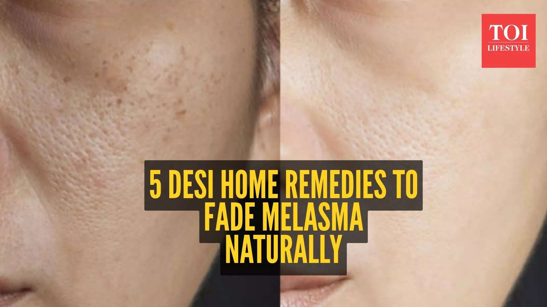 5 home remedies to get rid of Melasma (Jhai)